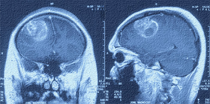 i research results kundawell glioblastoma multiforme 3